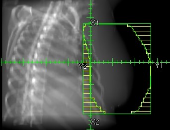 3D-konformale Bestrahlung